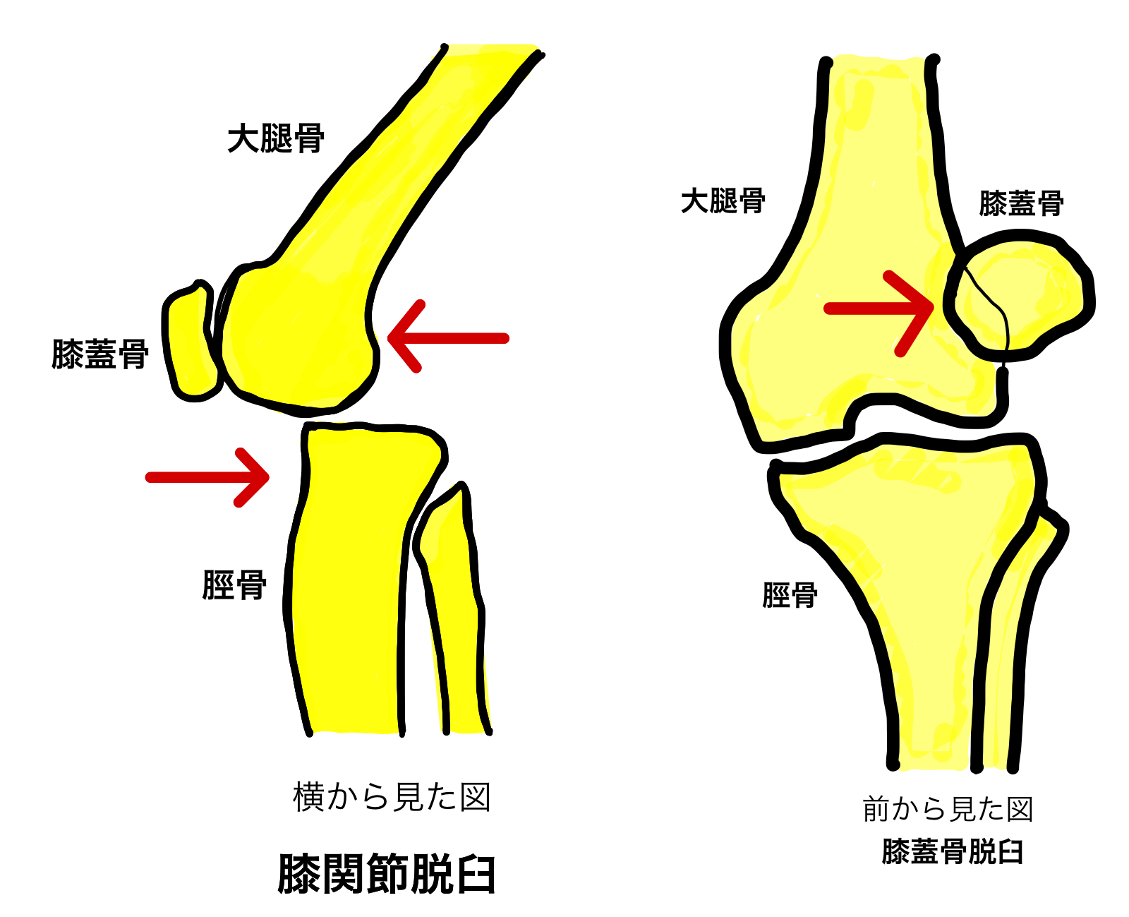 膝関節脱臼 vs 膝蓋骨脱臼