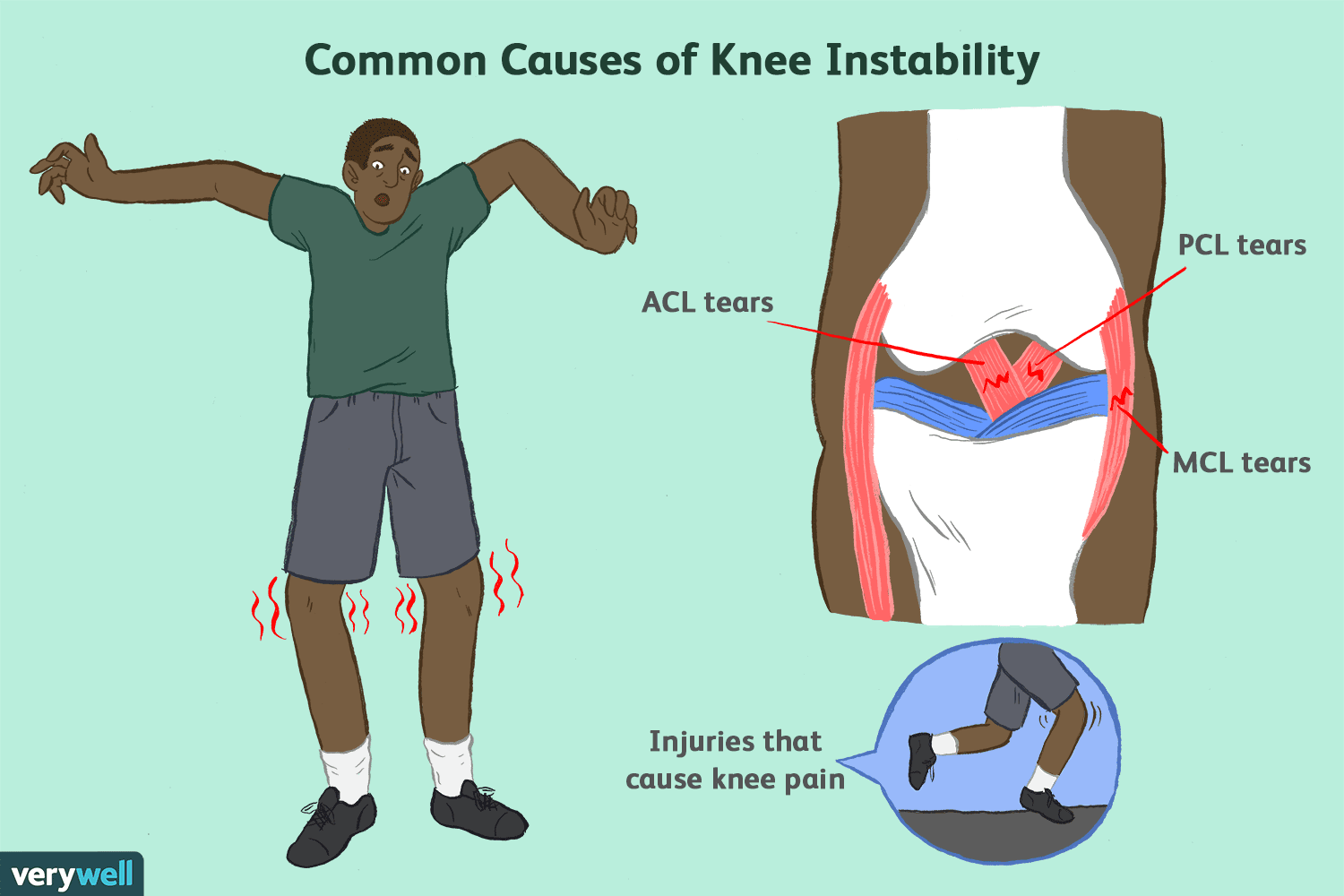 knee-pain-instability-2549493-5c04aaf946e0fb00010b8e7a