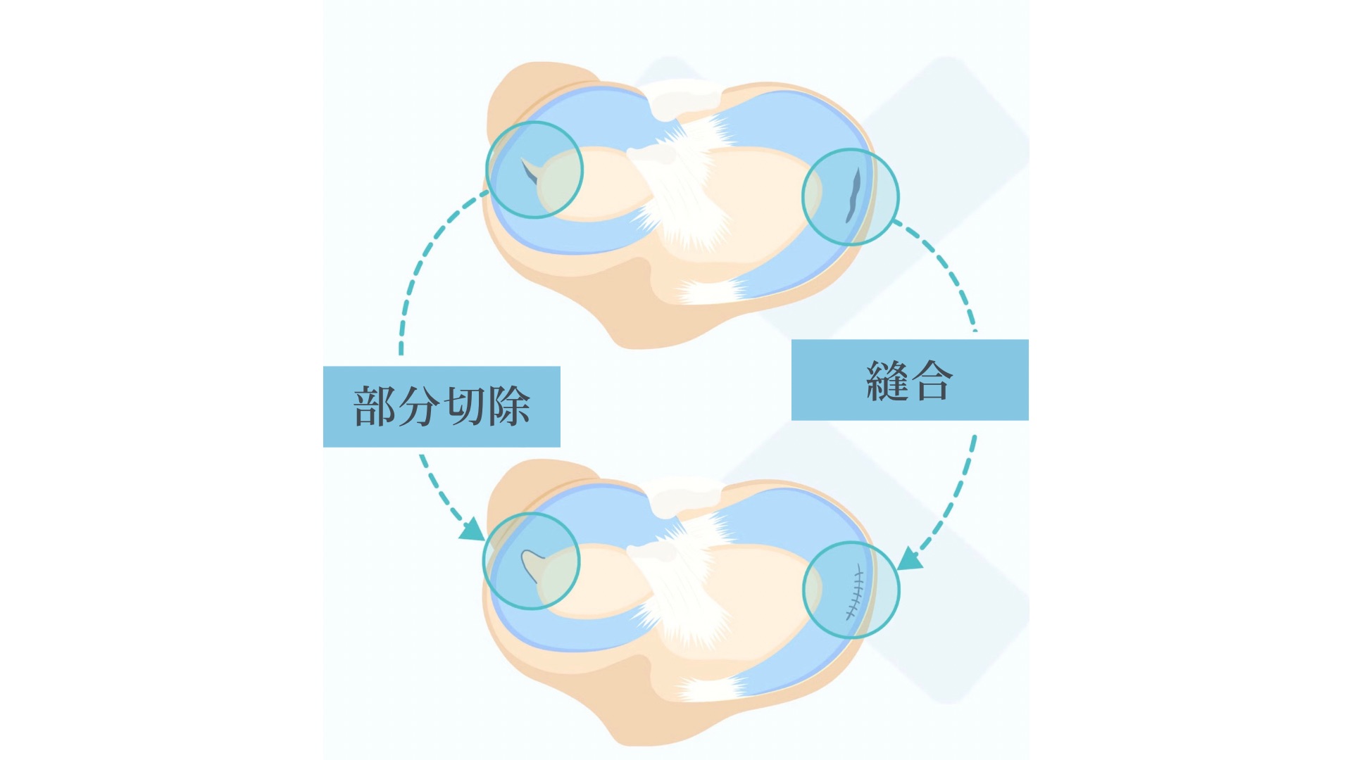 部分切除と縫合